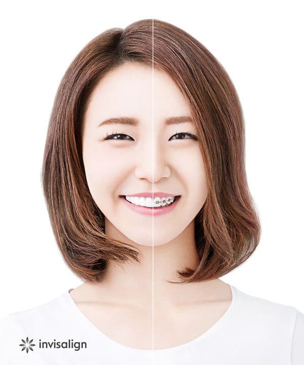 インビザライン